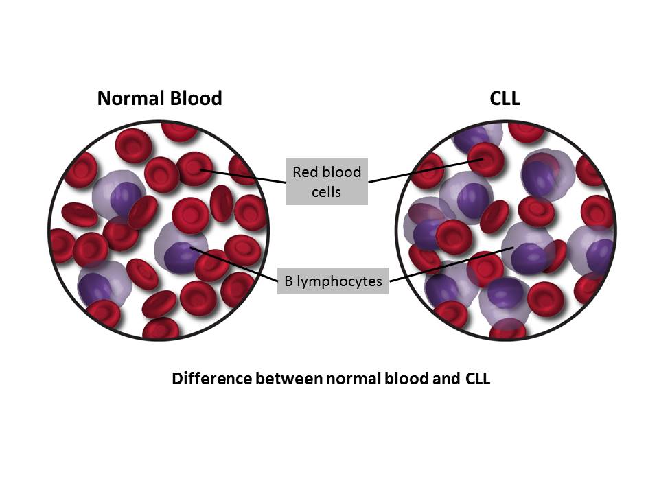 Normal Blood & CLL