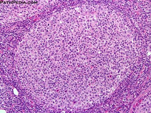 Obinutuzumab Reduces Risk of Disease Progression in Follicular Lymphoma
